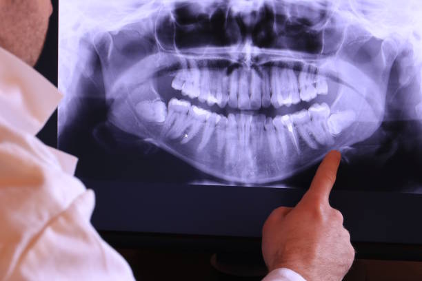 Best Emergency Wisdom Teeth Removal in Brentwood, MD